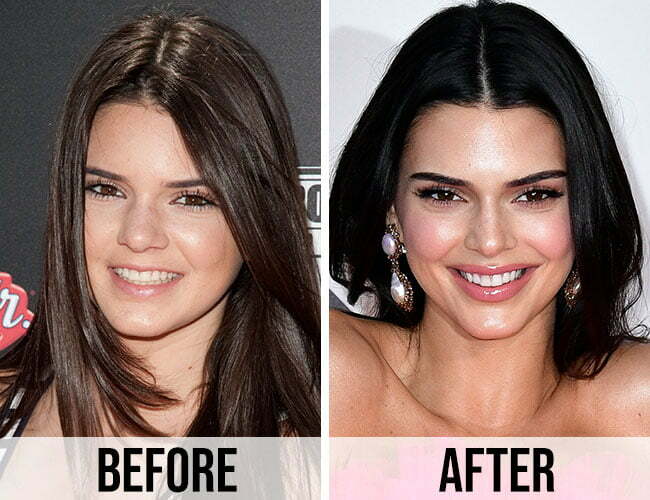 kendall jenner nose job