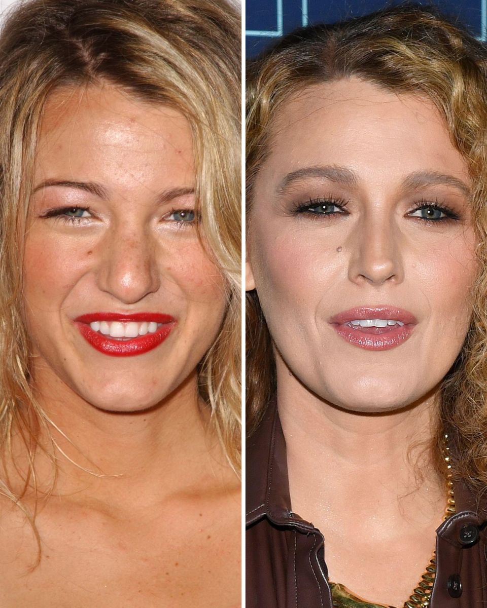 Blake Lively Before and After: The Subtle Transformation of Her Nose ...