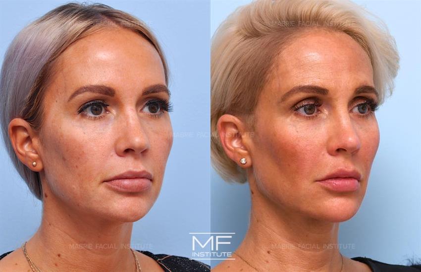 cheek filler before and after