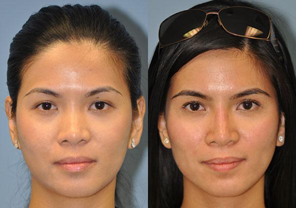 non surgical nose job