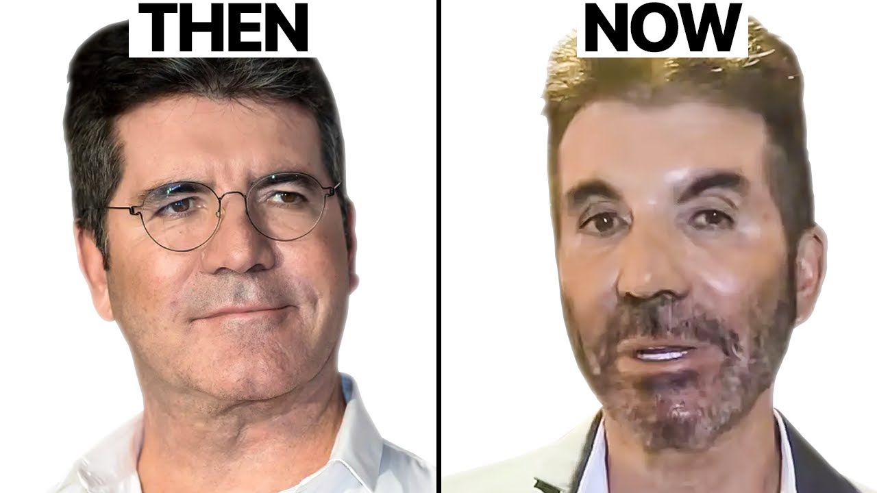 simon cowell plastic surgery