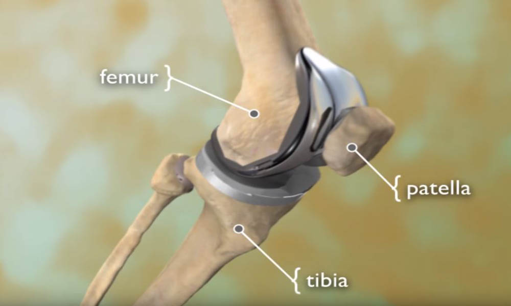 total knee replacement video